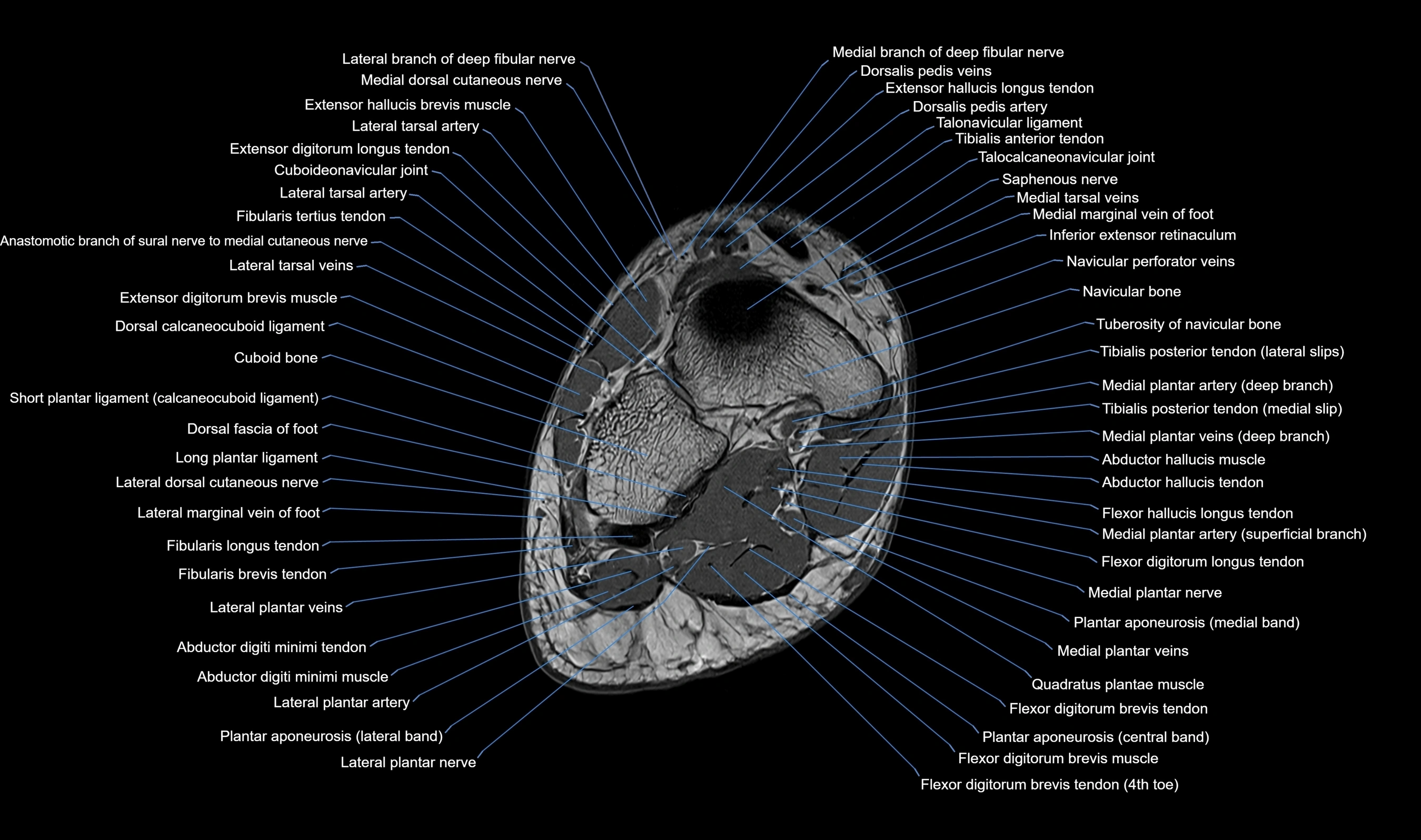 MRI mid foot axial cross sectional anatomy 3T  radiology  image-img-00001-00031.webp